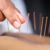 Top 3 Health Concerns Treated By Acupuncture