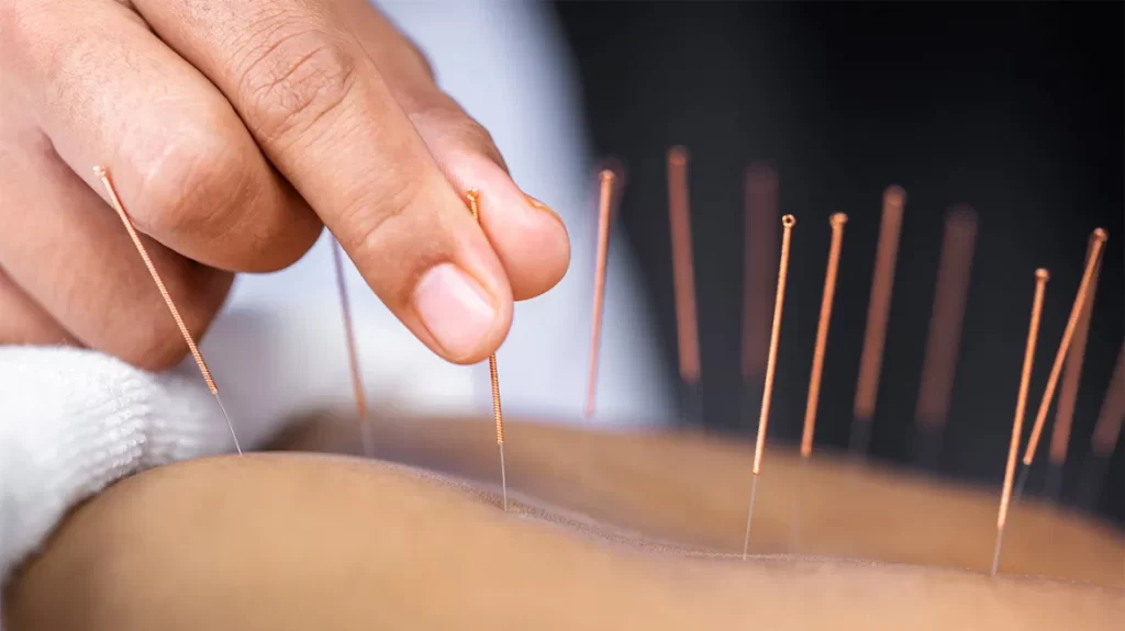 Top 3 Health Concerns Treated By Acupuncture